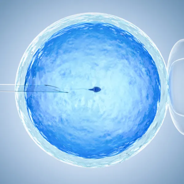 Intracytoplasmic Sperm Injection (ICSI)