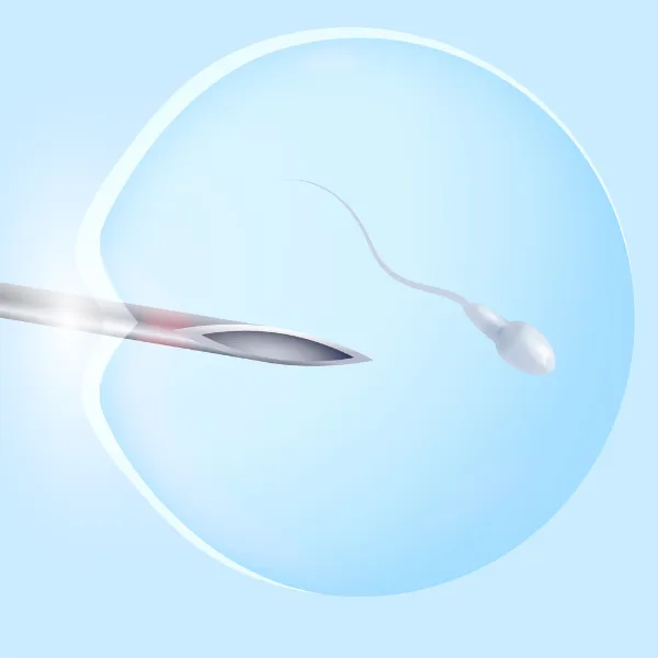 Intrauterine Insemination (IUI)