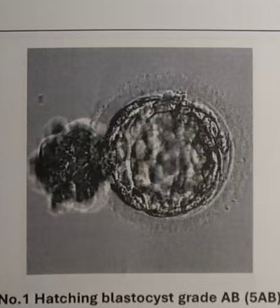 40岁患者移植5AB囊胚影像